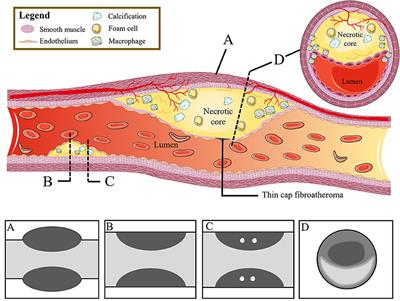 Frontiers Coronary Computed Tomography Angiography Assessment Of High